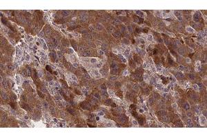ABIN6277371 at 1/100 staining Human liver cancer tissue by IHC-P. (GRPR anticorps  (Internal Region))