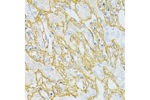 Immunohistochemistry of paraffin-embedded human liver cancer using TGFBI antibody (ABIN5971386) at dilution of 1/100 (40x lens). (TGFBI anticorps)