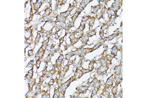 Immunohistochemistry of paraffin-embedded human thyroid cancer using GARS Rabbit pAb (ABIN6127942, ABIN6140964, ABIN6140966 and ABIN6221085) at dilution of 1:300 (40x lens).
