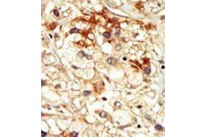 Formalin-fixed and paraffin-embedded human cancer tissue reacted with the primary antibody, which was peroxidase-conjugated to the secondary antibody, followed by DAB staining. (CDK17 anticorps  (N-Term))