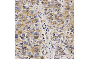 Immunohistochemistry of paraffin-embedded human liver cancer using VAPB Antibody (ABIN5973099) at dilution of 1/200 (40x lens). (VAPB anticorps)