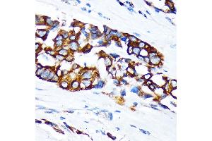 Immunohistochemistry of paraffin-embedded human lung cancer using KRT36 Rabbit pAb (ABIN6130229, ABIN6143029, ABIN6143030 and ABIN6217868) at dilution of 1:100 (40x lens). (Keratin 36 anticorps  (AA 388-467))