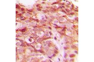 Immunohistochemical analysis of DNAJB4 staining in human breast cancer formalin fixed paraffin embedded tissue section.