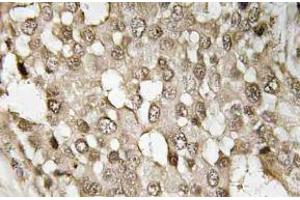 Immunohistochemistry (IHC) analyzes of p-NFkappaB-p65 antibody in paraffin-embedded human breast carcinoma tissue. (NF-kB p65 anticorps  (pSer529))