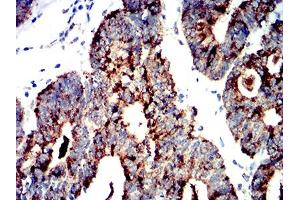 Immunohistochemical analysis of paraffin-embedded rectum cancer tissues using PRKAA2 mouse mAb with DAB staining.