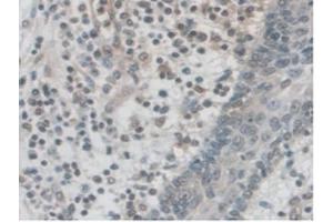 IHC-P analysis of Human Skin Cancer Tissue, with DAB staining. (PALLD anticorps  (AA 1137-1383))