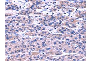 The image on the left is immunohistochemistry of paraffin-embedded Human liver cancer tissue using ABIN7131486(TRIM49 Antibody) at dilution 1/40, on the right is treated with fusion protein. (TRIM49 anticorps)