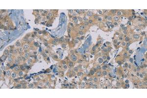 Immunohistochemistry of paraffin-embedded Human breast cancer using RAD51 Polyclonal Antibody at dilution of 1:40 (RAD51 anticorps)