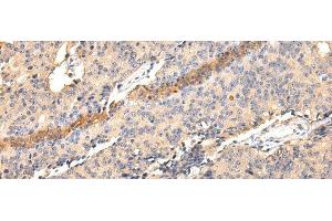 Immunohistochemistry of paraffin-embedded Human prostate cancer using SDCBP Polyclonal Antibody at dilution of 1/40