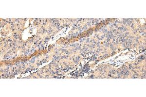 Immunohistochemistry of paraffin-embedded Human prostate cancer using SDCBP Polyclonal Antibody at dilution of 1/40 (SDCBP anticorps)
