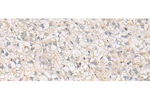 Immunohistochemistry of paraffin-embedded Human liver cancer tissue using TNNT1 Polyclonal Antibody at dilution of 1:35(x200)