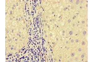 Immunohistochemistry of paraffin-embedded human liver cancer using ABIN7160331 at dilution of 1:100 (FAT Atypical Cadherin 2 (FAT2) (AA 123-314) anticorps)