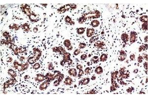 Immunohistochemistry of paraffin-embedded Human breast carcinoma tissue with Phospho-ERK 1/2 (Tyr222/205) Monoclonal Antibody at dilution of 1:200 (ERK1/2 anticorps  (pTyr205, pTyr222))