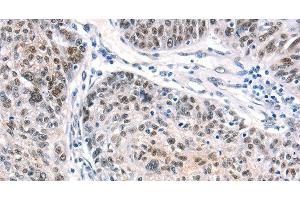 Immunohistochemistry of paraffin-embedded Human ovarian cancer using CTBP2 Polyclonal Antibody at dilution of 1:40 (CTBP2 anticorps)