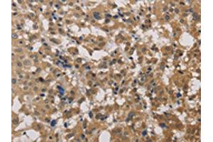 The image on the left is immunohistochemistry of paraffin-embedded Human thyroid cancer tissue using ABIN7129190(DEGS1 Antibody) at dilution 1/40, on the right is treated with fusion protein. (DEGS1 anticorps)