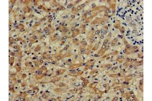 Immunohistochemistry of paraffin-embedded human liver cancer using ABIN7148969 at dilution of 1:100
