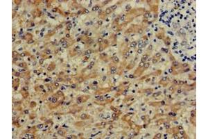 Immunohistochemistry of paraffin-embedded human liver cancer using ABIN7148969 at dilution of 1:100 (CTH anticorps  (AA 1-70))
