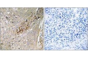 Immunohistochemistry analysis of paraffin-embedded human lung carcinoma tissue, using SLC6A6 Antibody. (TAUT anticorps  (AA 561-610))