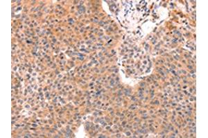 The image on the left is immunohistochemistry of paraffin-embedded Human liver cancer tissue using ABIN7129152(DAZ4 Antibody) at dilution 1/50, on the right is treated with fusion protein. (DAZ4 anticorps)