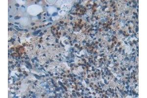 Detection of CC16 in Human Lung cancer Tissue using Polyclonal Antibody to Clara Cell Protein 16 (CC16)