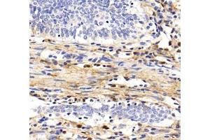 Immunohistochemistry analysis of paraffin-embedded human colon cancer using MFAP4 (ABIN7074614) at dilution of 1: 2000