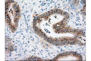 Immunohistochemical staining of paraffin-embedded Adenocarcinoma of colon tissue using anti-BSG mouse monoclonal antibody. (CD147 anticorps)