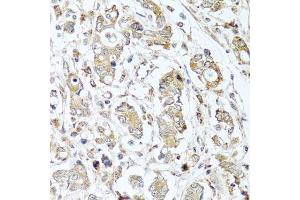 Immunohistochemistry of paraffin-embedded human gastric cancer using CPA1 antibody. (CPA1 anticorps)