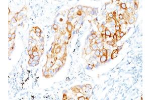 Formalin-fixed, paraffin-embedded human Lung SCC stained with Cytokeratin 7/17 Mouse Monoclonal Antibody (C-46). (Keratin 7/17 anticorps)