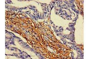 Immunohistochemistry of paraffin-embedded human colon cancer using ABIN7144568 at dilution of 1:100