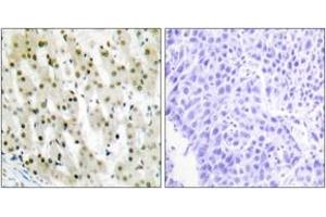Immunohistochemistry analysis of paraffin-embedded human liver carcinoma tissue, using hnRNP A1 Antibody.
