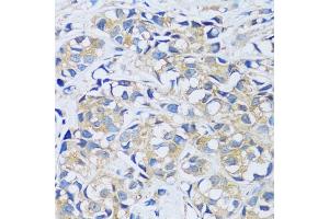 Immunohistochemistry of paraffin-embedded human breast cancer using C antibody (ABIN6129635, ABIN6137807, ABIN6137808 and ABIN6217796) at dilution of 1:100 (40x lens).