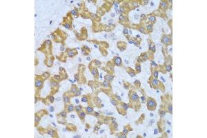 Immunohistochemistry of paraffin-embedded human liver cancer using PRKCD antibody at dilution of 1:100 (40x lens). (PKC delta anticorps)