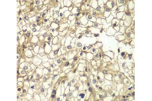 Immunohistochemistry of paraffin-embedded Human kidney cancer using CD1D Polyclonal Antibody at dilution of 1:200 (40x lens). (CD1d anticorps)
