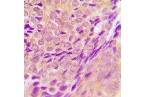 Immunohistochemical analysis of ZADH2 staining in human breast cancer formalin fixed paraffin embedded tissue section.