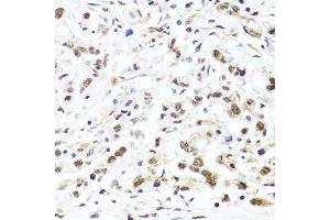Immunohistochemistry of paraffin-embedded human gastric cancer using HIRA antibody.