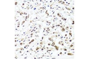 Immunohistochemistry of paraffin-embedded human gastric cancer using HIRA antibody. (HIRA anticorps  (AA 250-550))