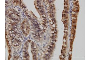 Immunoperoxidase of monoclonal antibody to S100A6 on formalin-fixed paraffin-embedded human stomach carcinoma.