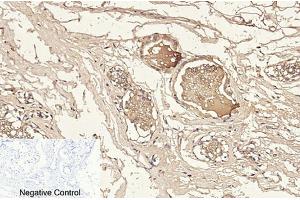 Immunohistochemical analysis of paraffin-embedded human breast tissue. (Caspase 3 p12 (AA 130-210), (Cleaved-Asp175) anticorps)