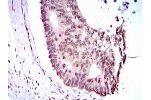 Immunohistochemical analysis of paraffin-embedded rectum cancer tissues using KLF1 mouse mAb with DAB staining.