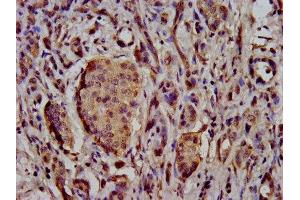 IHC image of ABIN7169920 diluted at 1:500 and staining in paraffin-embedded human pancreatic cancer performed on a Leica BondTM system. (SCN11A anticorps  (AA 403-551))