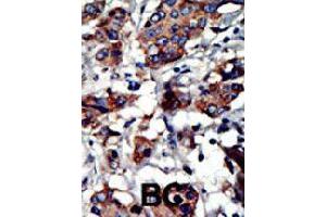 Formalin-fixed and paraffin-embedded human cancer tissue reacted with PACSIN3 polyclonal antibody  , which was peroxidase-conjugated to the secondary antibody, followed by AEC staining. (PACSIN3 anticorps  (N-Term))