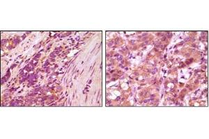 Immunohistochemical analysis of paraffin-embedded human stomach carcinoma (left) and breast carcinoma (right), showing cytoplasmic localization using fibulin5 antibody with DAB staining. (Fibulin 5 anticorps)