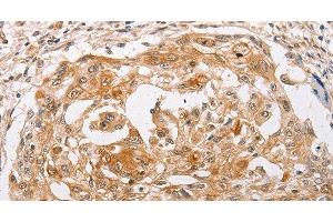 Immunohistochemistry of paraffin-embedded Human cervical cancer using PPP1CB Polyclonal Antibody at dilution of 1:30 (PPP1CB anticorps)