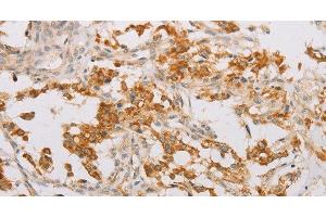 Immunohistochemistry of paraffin-embedded Human thyroid cancer tissue using STK40 Polyclonal Antibody at dilution 1:40