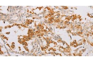 Immunohistochemistry of paraffin-embedded Human thyroid cancer tissue using STK40 Polyclonal Antibody at dilution 1:40 (STK40 anticorps)
