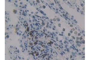 Detection of MCP4 in Human Lung cancer Tissue using Polyclonal Antibody to Monocyte Chemotactic Protein 4 (MCP4)
