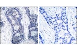 Immunohistochemistry analysis of paraffin-embedded human breast carcinoma tissue, using eIF4E (Ab-209) Antibody. (EIF4E anticorps  (AA 168-217))