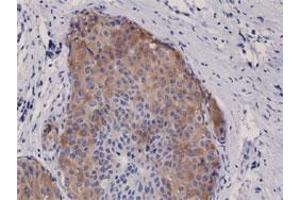 Immunohistochemical staining (Formalin-fixed paraffin-embedded sections) of human breast cancer with ACACA/ACACB (phospho S79) monoclonal antibody, clone RM270 . (Acetyl-CoA Carboxylase alpha anticorps  (pSer79))