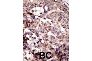 IHC analysis of formalin-fixed paraffin-embedded human cancer tissue (breast carcinoma) with RAGE antibody, which was peroxidase-conjugated to the secondary antibody, followed by AEC staining.