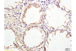 Formalin-fixed and paraffin embedded human rectal carcinoma tissue labeled with Anti HHLA2 Polyclonal Antibody, Unconjugated (ABIN1388019) at 1:200 followed by conjugation to the secondary antibody and DAB staining (HHLA2 anticorps  (AA 231-330))